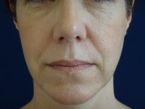 Hyaluronbehandlung mit Galderma in der Villa Bella München: vor der Unterspritzung der Nasolabialfalte.