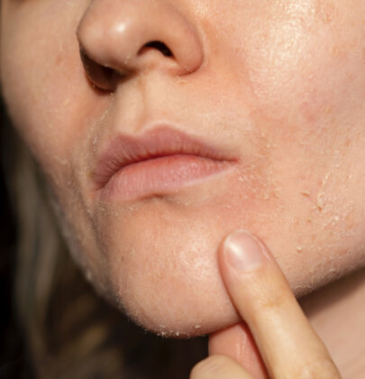 Periorale Dermatitis – Haut im Ausnahmezustand