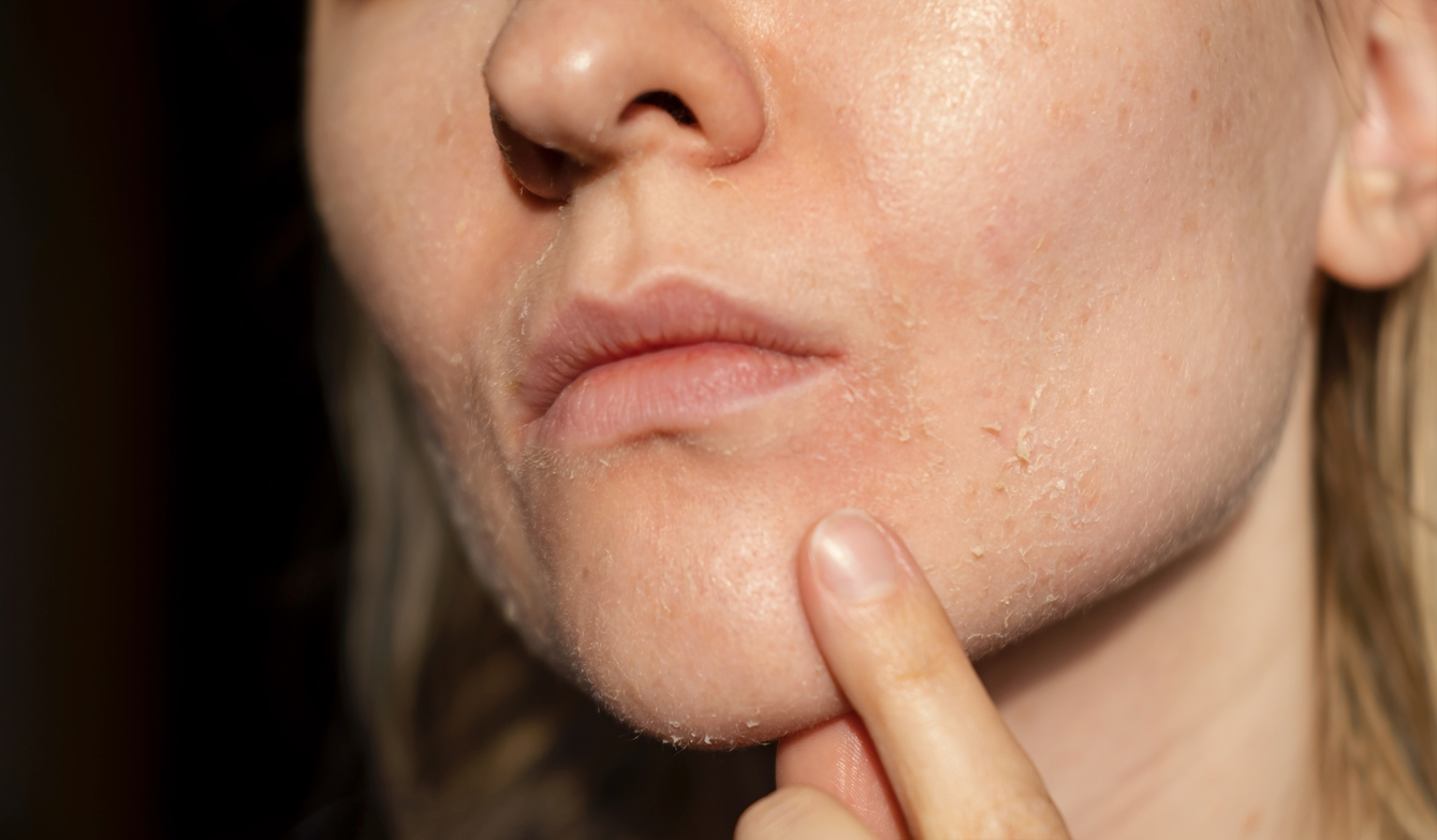 Alles über perioale Dermatitis und ihre Behandlungsmöglichkeiten auf schminktante.de. Anja Frankenhäuser, Beautyblog, Hautkrankheit, Stewardessenkrankheit